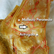 distorsione della caviglia