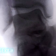 distorsione della caviglia