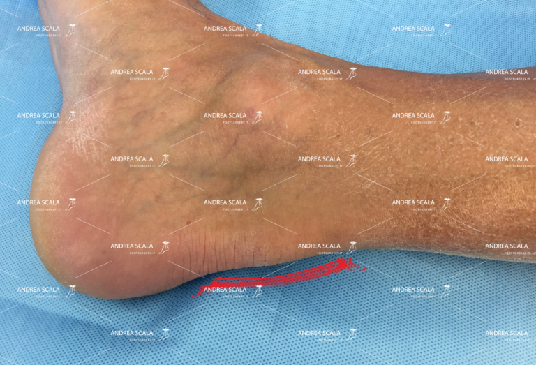 disturbi tendine d’Achille