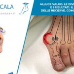 Alluce valgo. Le diverse tecniche e i risultati. Il delirio delle recidive. Come orientarsi?
