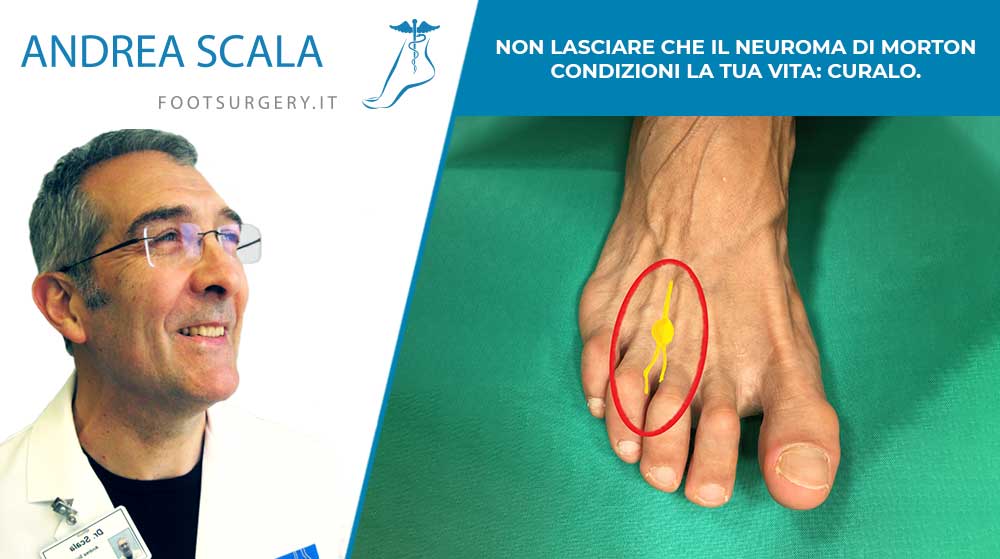 Non lasciare che il neuroma di Morton condizioni la tua vita: curalo.