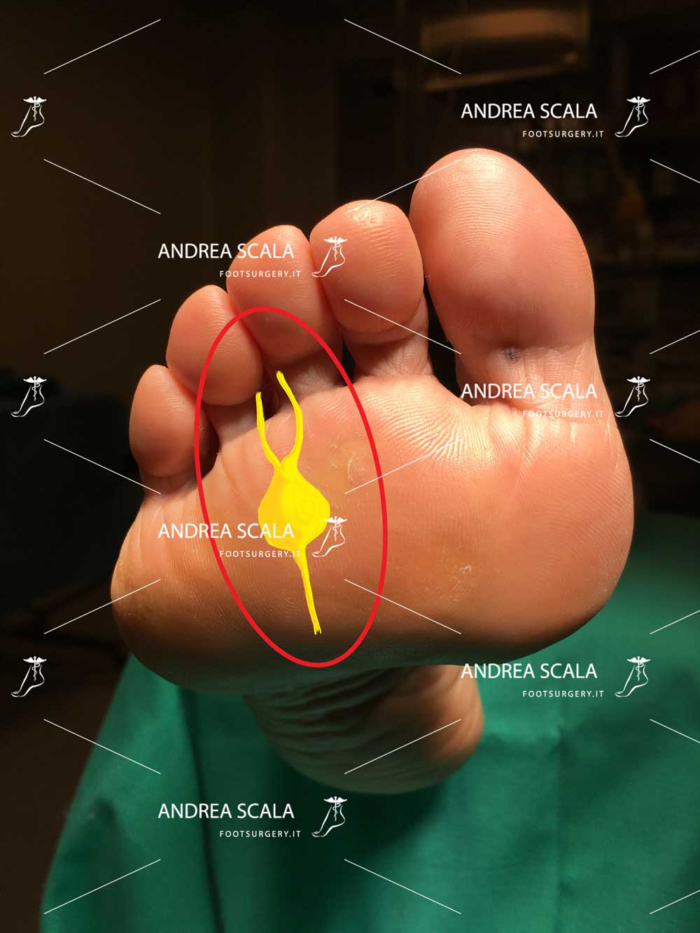 Lo schema mostra la localizzazione a livello plantare della infiammazione del nervo (neuroma) a livello del 3° e 4° metatarso e del 3° e 4° dito.