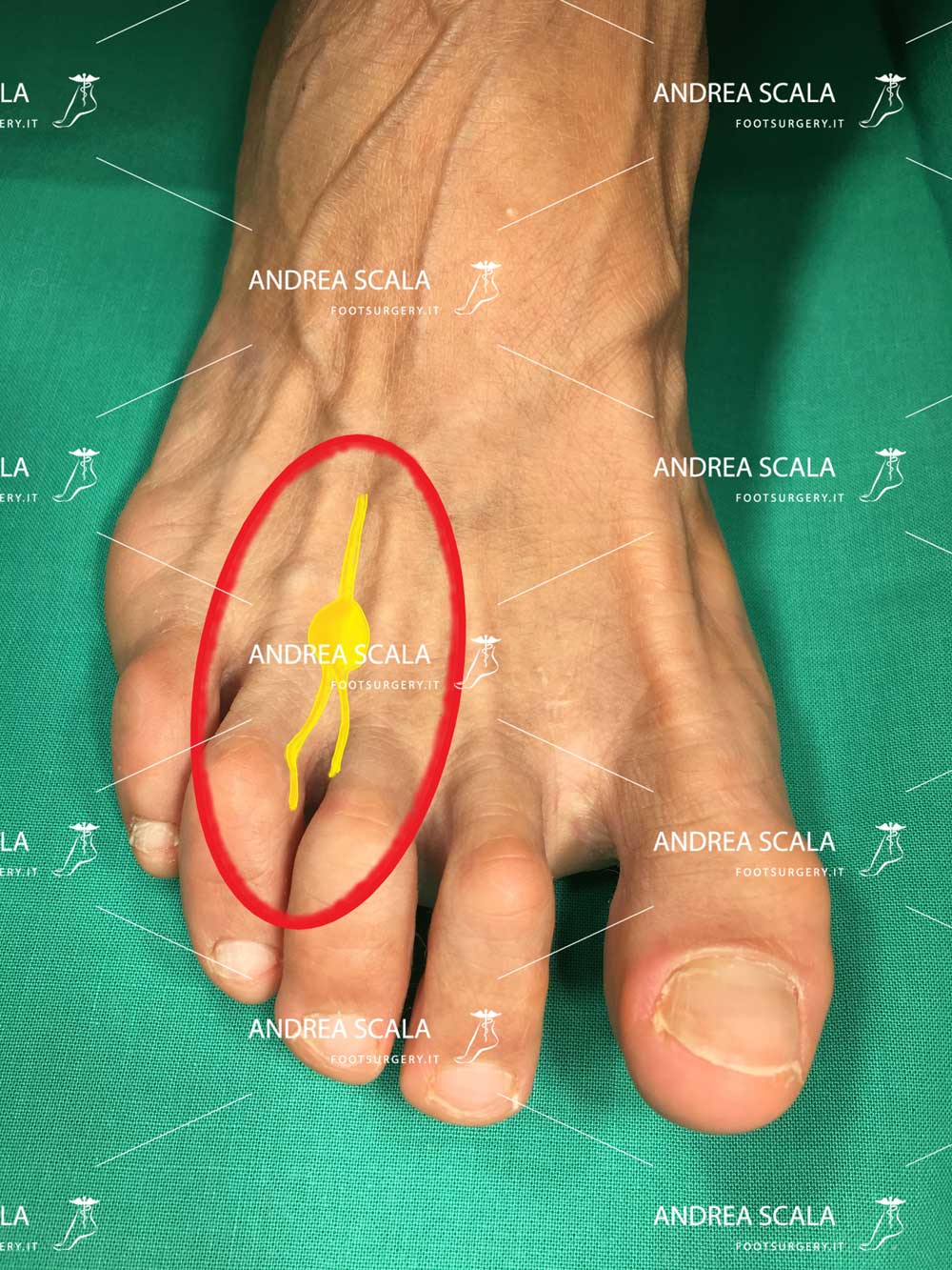 neuroma di Morton