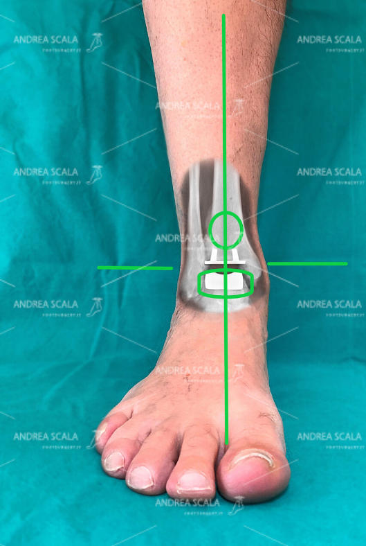 Protesi di caviglia: i tempi del il recupero post-operatorio 