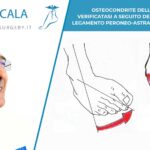 OSTEOCONDRITE DELL'ASTRAGALO