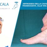 Artrodesi della caviglia non è una passeggiata