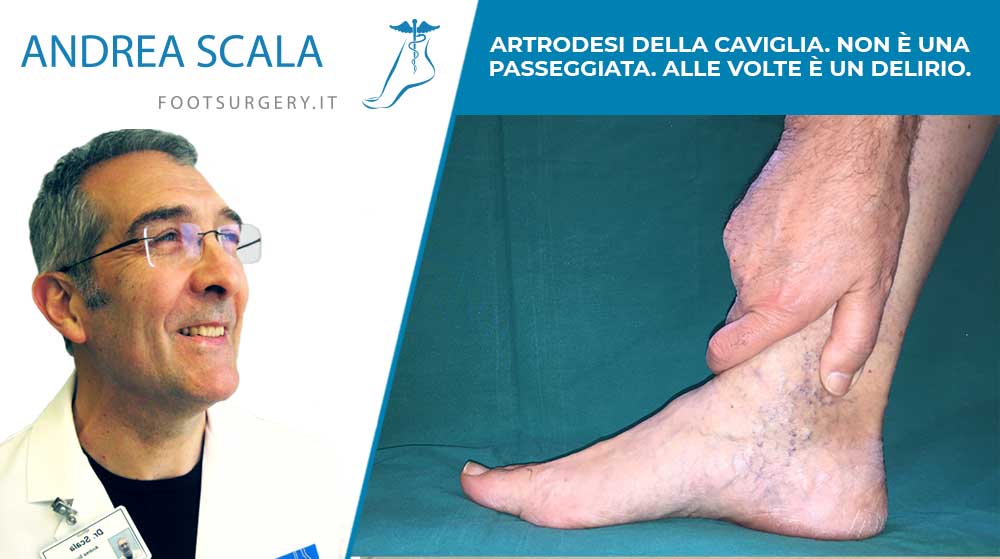 Artrodesi della caviglia non è una passeggiata