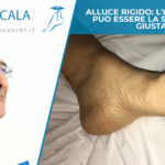 Alluce rigido: l'intervento può essere la soluzione giusta