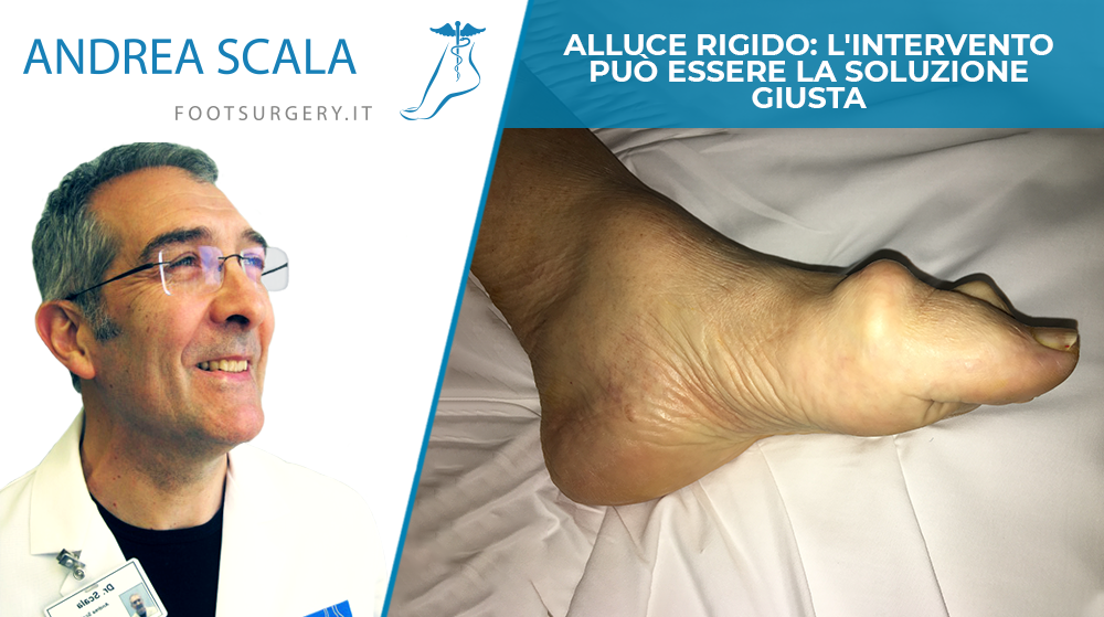 Alluce rigido: l'intervento può essere la soluzione giusta
