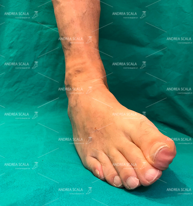 Rottura legamenti della caviglia