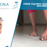 Piede equino: quale terapia seguire?