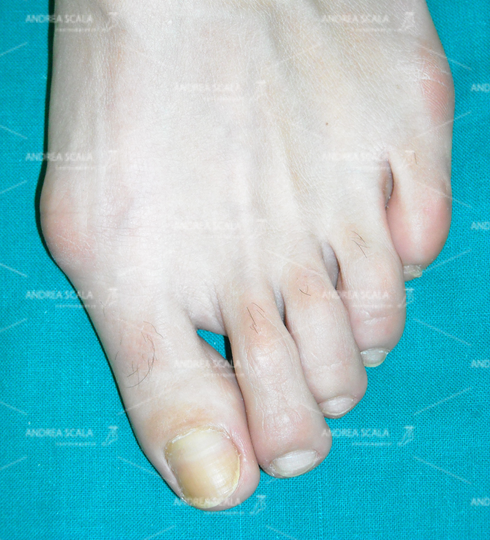 La foto mostra un quadro di alluce valgo.