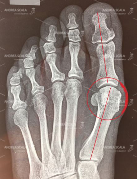 La Rxgrafia mostra il caso di alluce valgo prima dell’intervento.