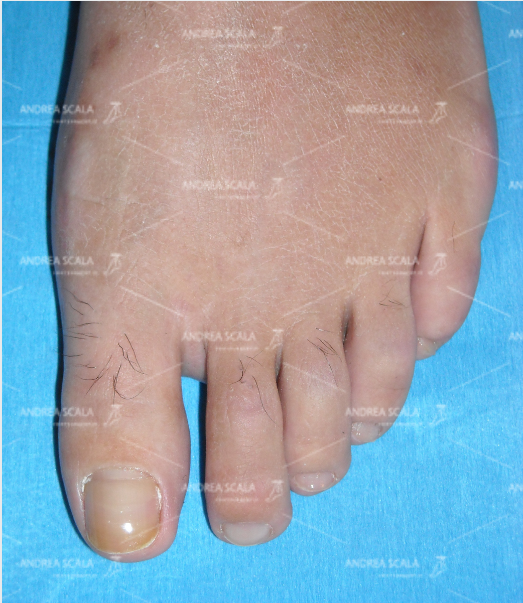 La foto mostra l’alluce dopo l’intervento del Dott. Scala.