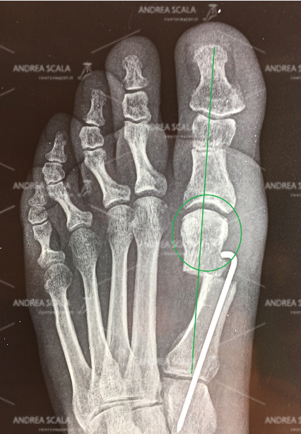 La Rxgrafia mostra la tecnica del dott. Scala . Il 1° metatarso viene sezionato e poi spostato lateralmente per essere infine allineato nuovamente con gli altri metatarsi. Il filo metallico protegge la correzione. Il 1° metatarso e l’alluce non si possano più spostare nuovamente.