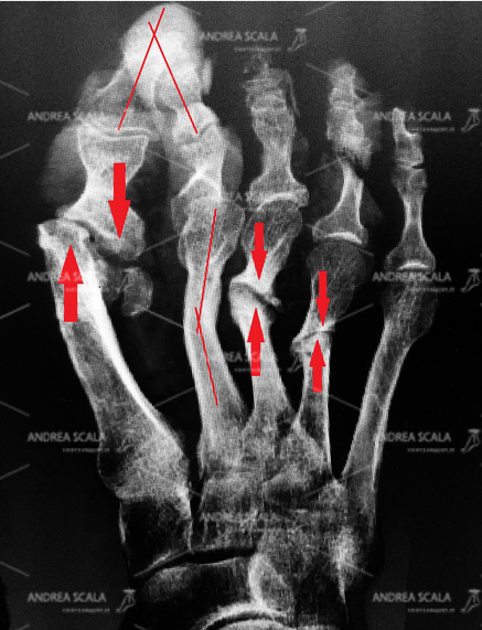 La Rxgrafia mostra un intervento per alluce valgo e metatarsalgia eseguito altrove e  senza la opportuna fissazione. Tutte le ossa sono state tagliate con un frullino, non sono state fissate, si sono tutte spostate, creando un disastro.