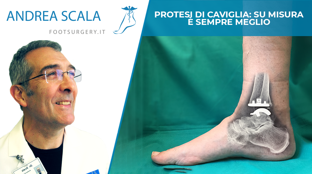 Protesi di caviglia: su misura è sempre meglio