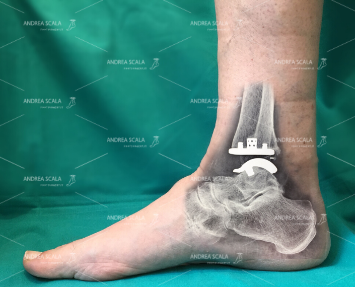 Protesi di caviglia: su misura è sempre meglio 