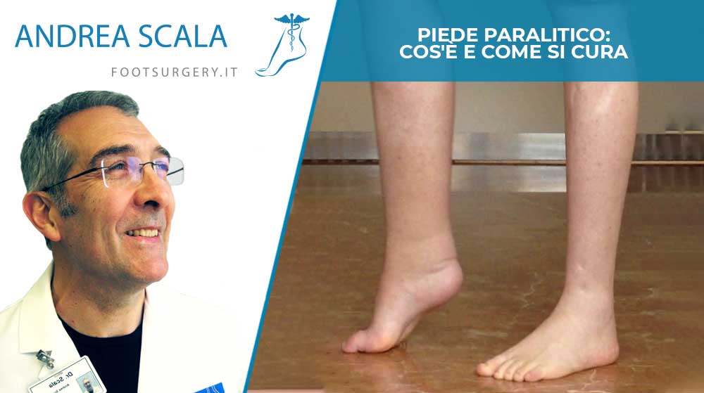 Piede paralitico: cos'è e come si cura