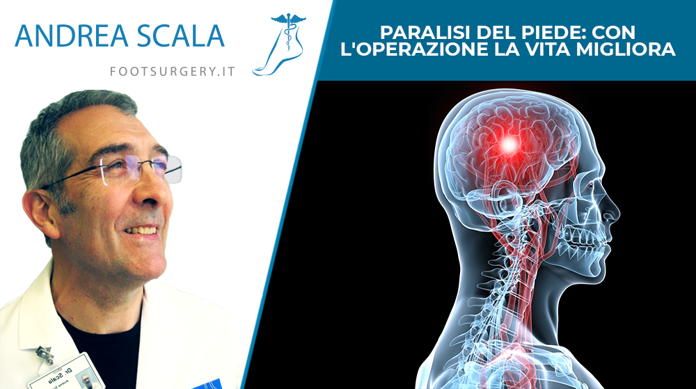 Paralisi del piede: con l'operazione la vita migliora