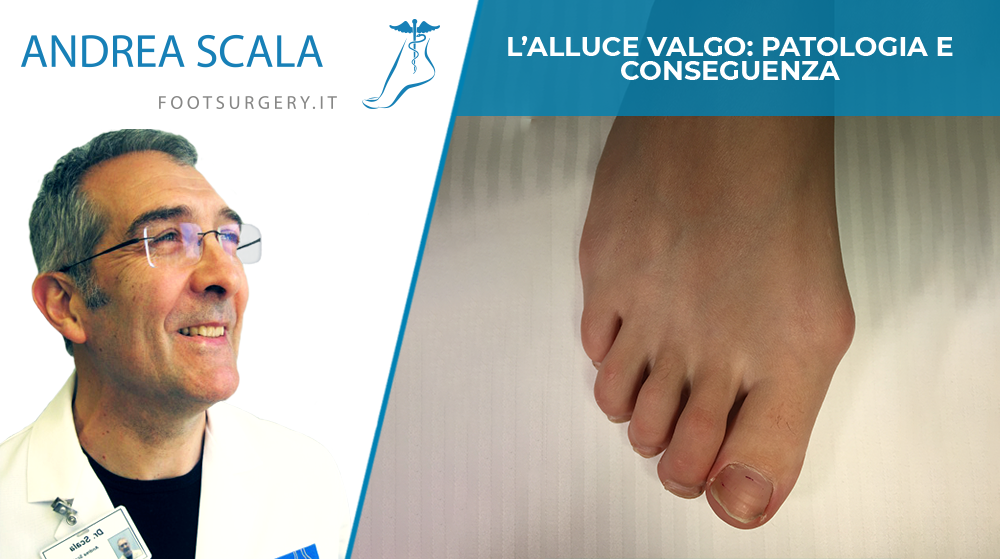 alluce valgo