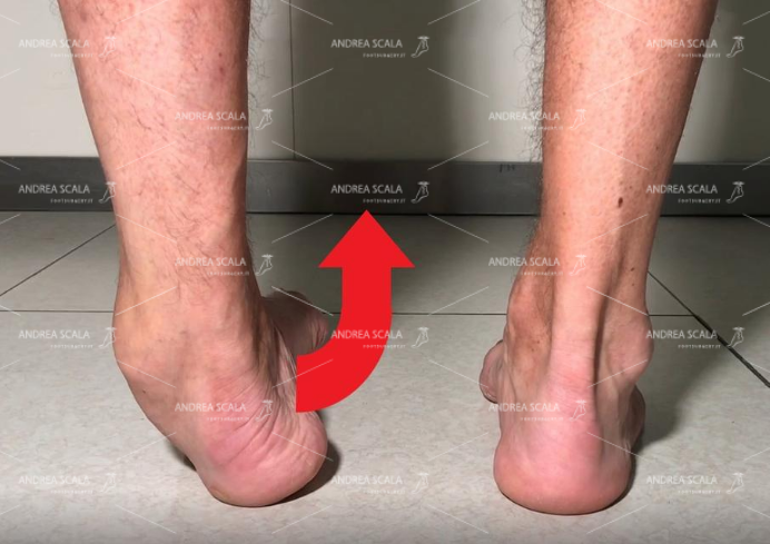 La foto mostra l’avampiede affetto da metatarsalgia, con deformità delle dita.