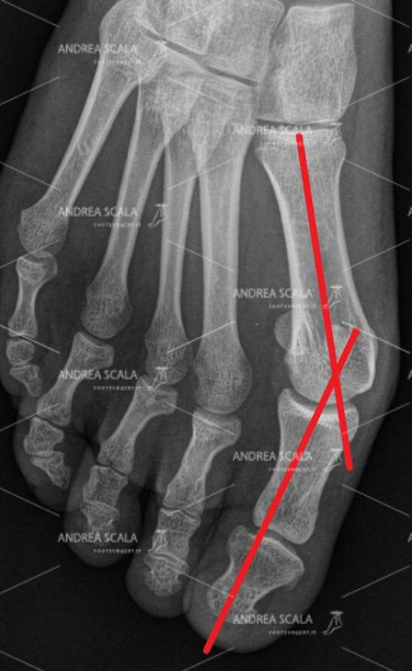 La RXgrafia del piede sottocarico mostra che l’alluce ed il primo metatarso non sono in asse. Il 1° metatarso è spostato e la testa sporge sotto la cute (cipolla). Si vede molto bene la deviazione dell’alluce.