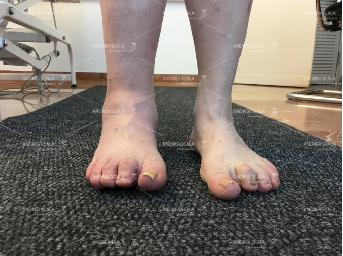 Il piede torto congenito: cos’è, cura e mantenimento