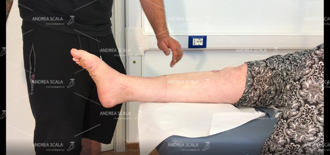 La paziente è rilasciata e porta la caviglia in flessione plantare