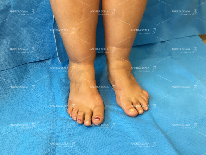 caviglie-piedi-gonfi.jpeg