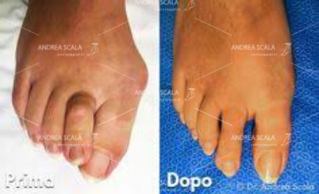 alluce-valgo-operato-dott-andrea-scala.jpeg
