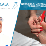 Neuroma di Morton recidivo