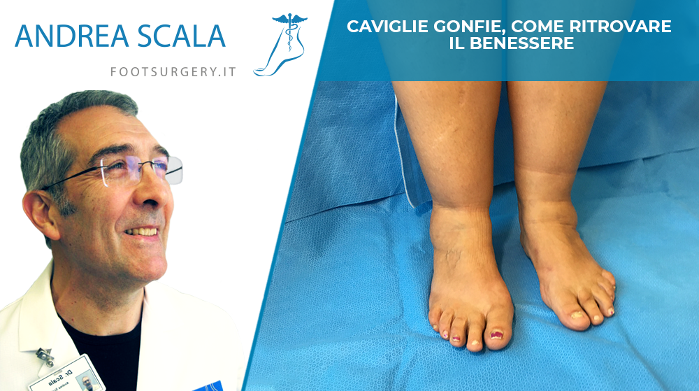 Caviglie gonfie, come ritrovare il benessere