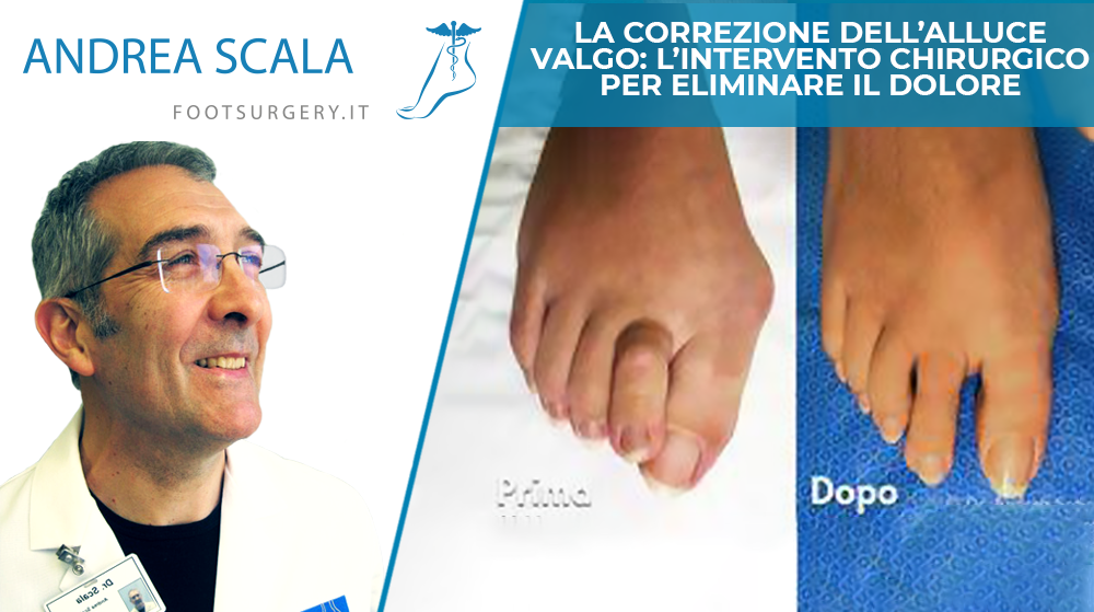 alluce-valgo-operato-dott-andrea-scala.jpeg