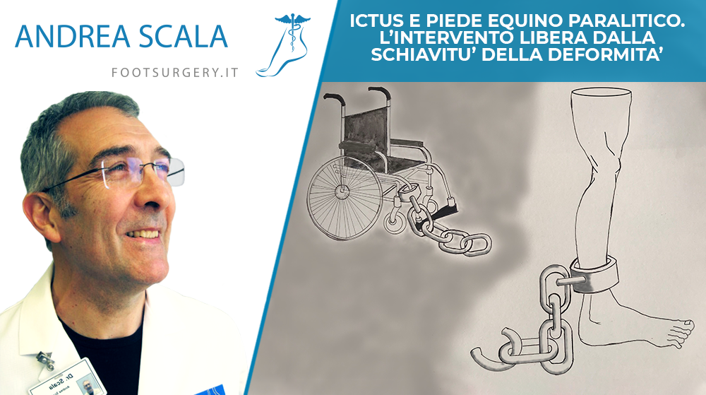 piede equino paralitico