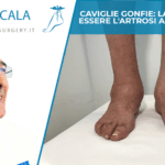 caviglie gonfie