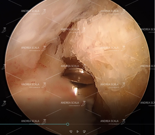 c) si vede la fresa motorizzata che ha iniziato la resezione del calcagno, in alto il tendine d’Achille, la borsite con l’infiammazione;
