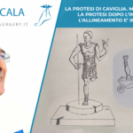 instabilità- della-caviglia Protesi di caviglia
