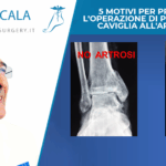 5 motivi per preferire l'operazione di protesi alla caviglia all'artrodesi