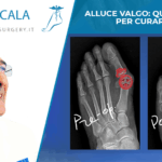 ALLUCE VALGO QUALI RIMEDI PER CURARLO