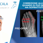 Correzione alluce valgo