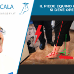 IL PIEDE EQUINO POST-ICTUS SI DEVE OPERARE
