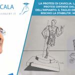 LA PROTESI DI CAVIGLIA. LA DURATA DELLA PROTESI DIPENDE DALLA STABILITA’
