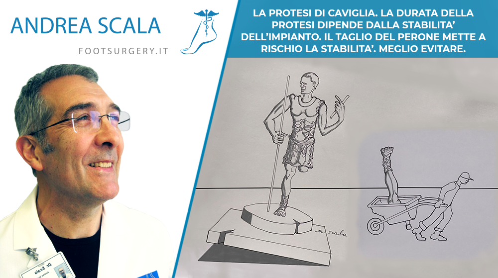 LA PROTESI DI CAVIGLIA. LA DURATA DELLA PROTESI DIPENDE DALLA STABILITA’