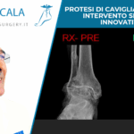 RX-PROTESI-DI-CAVIGLIA-PRE-POST-0