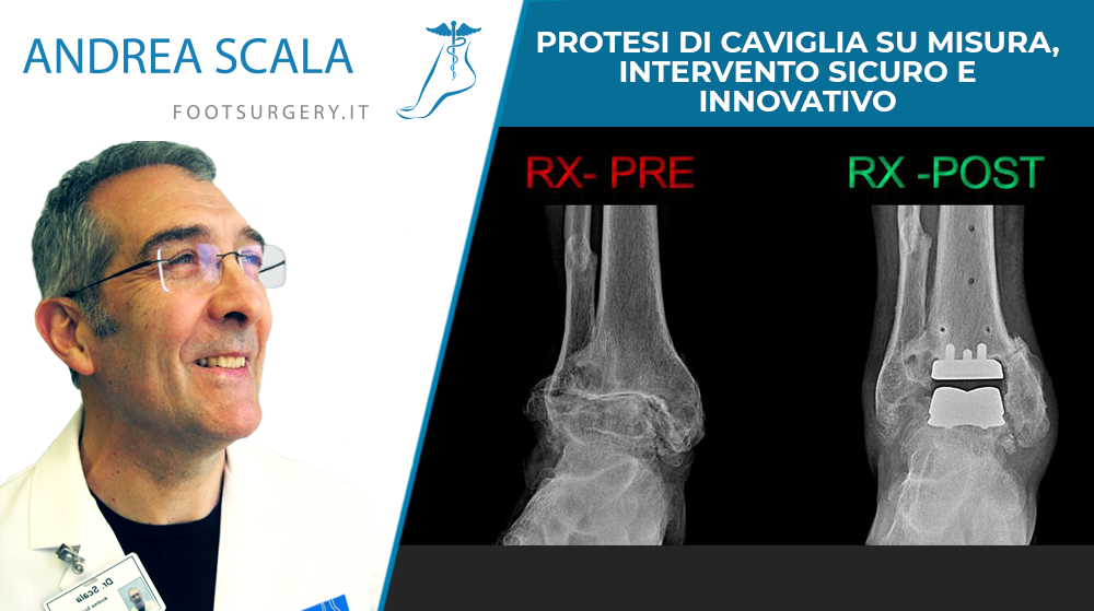 RX-PROTESI-DI-CAVIGLIA-PRE-POST-0