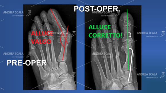 La RXgrafia mostra l’angolo di deviazione dell’alluce valgo prima dell’intervento. Anche il paziente può controllare da solo se l’alluce operato è stato messo bello diritto. Il sottile filo metallico che si vede è il sostegno dato all’alluce operato ed è l’assicurazione che l’alluce non tornerà mai più.