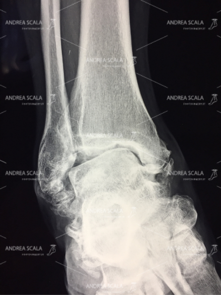 Quando i legamenti non vengono ricostruiti la cartilagine viene gravemente danneggiata. Si forma una artrosi deformante precoce.