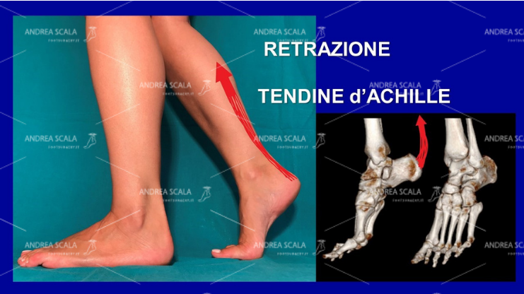 Lo schema mostra che la paralisi muscolare dovuta all’ictus provoca la retrazione del tendine d’Achille. A causa della paralisi il calcagno non appoggia al suolo. Nessun botulino e nessuna riabilitazione possono allungare il tendine d’Achille e fare toccare il calcagno al suolo. Solo l’intervento chirurgico può fare questa correzione. Solo chi ha uno scopo diverso insiste per anni con terapie inutili. Solo chi ha uno scopo diverso dalla correzione non comprende che la malattia del cervello non c’entra nulla con la paralisi del piede. Sono due cose distinte e separate.