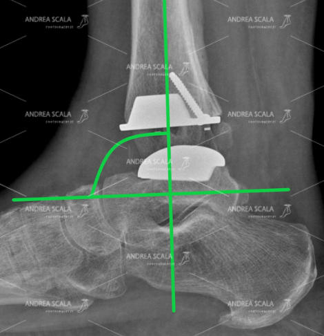 La RXgrafia laterale mostra la protesi della caviglia, le componenti sono ben allineate e si vede lo spazio articolare occupato dal polietilene mobile. L’accesso anteriore ha consentito di correggere la rigidità in equino. Non è stata eseguita la rottura del perone (gesto inutile nella via d’accesso anteriore). Il centro di rotazione è correttamente posizionato e non c’entra niente con la via d’accesso.